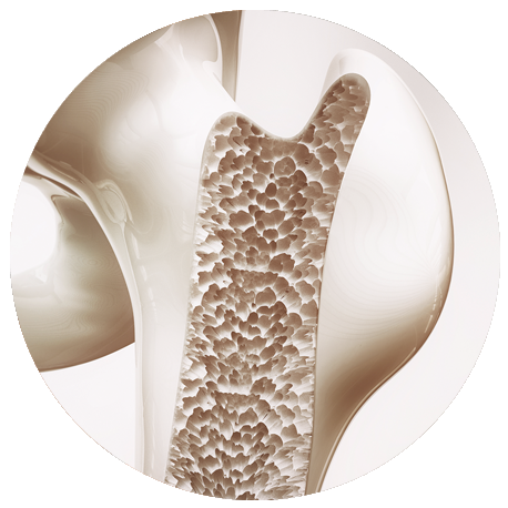 Querschnitt eines Knochens mit poröser, geschwächter innerer Struktur, die für Osteoporose steht.